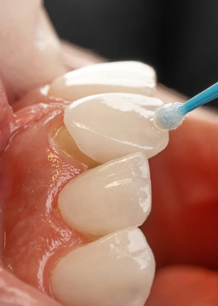 Cosmetic veneer treatment at Smile Bright Dental