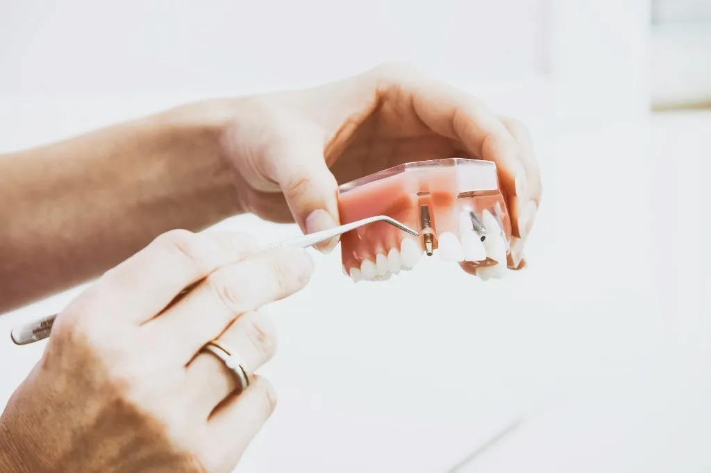 Dental Implants vs Bridges — Which Is Right for You?