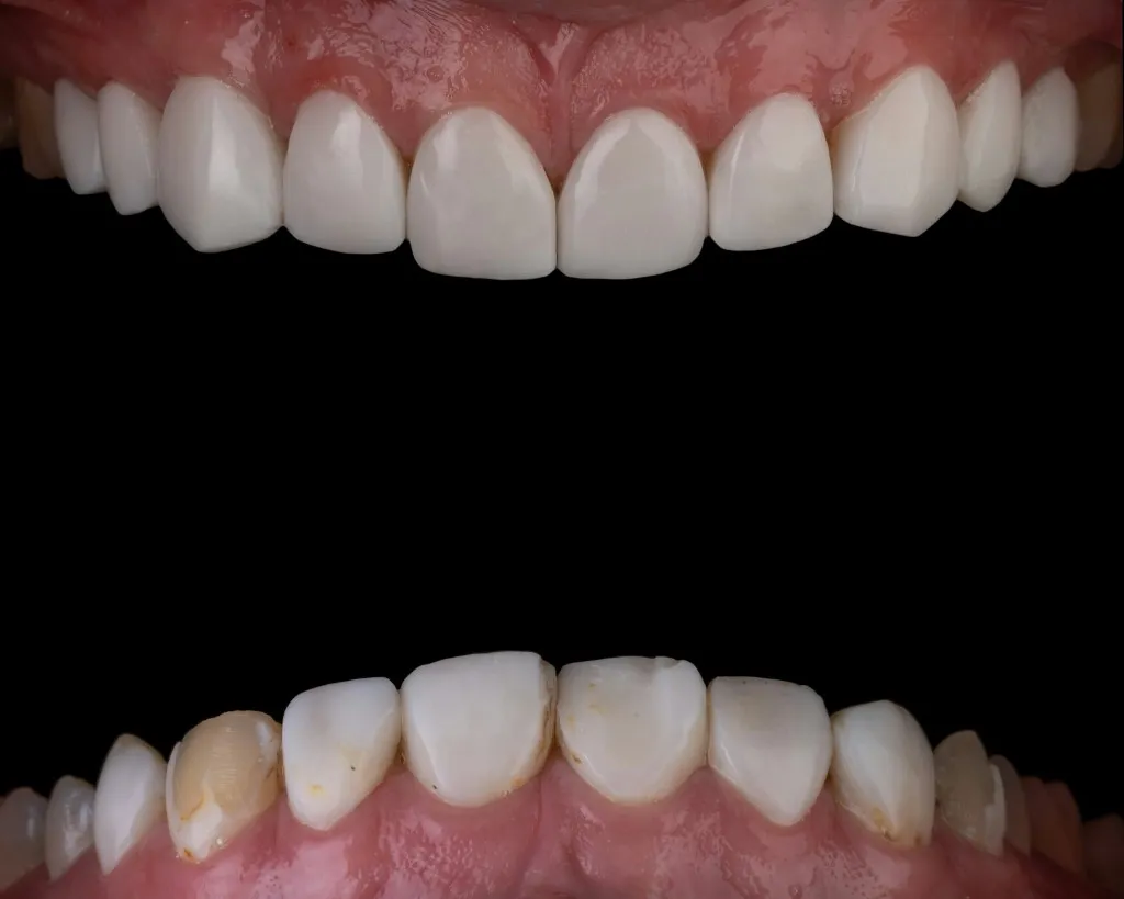 Teeth Whitening in Nairobi — Cost, What to Expect, and Results